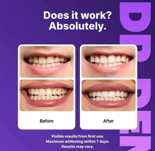 🌟 Guilt-Free Teeth Whitening Strips - Non-Toxic, Enamel-Safe, Instant Results in 30 Minutes